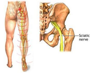 Sciatica Toronto, Sciatic Nerve Pain